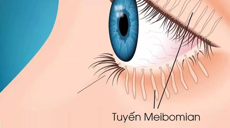 Chắp mắt tái phát nhiều lần nguyên nhân và cách chữa trị 2