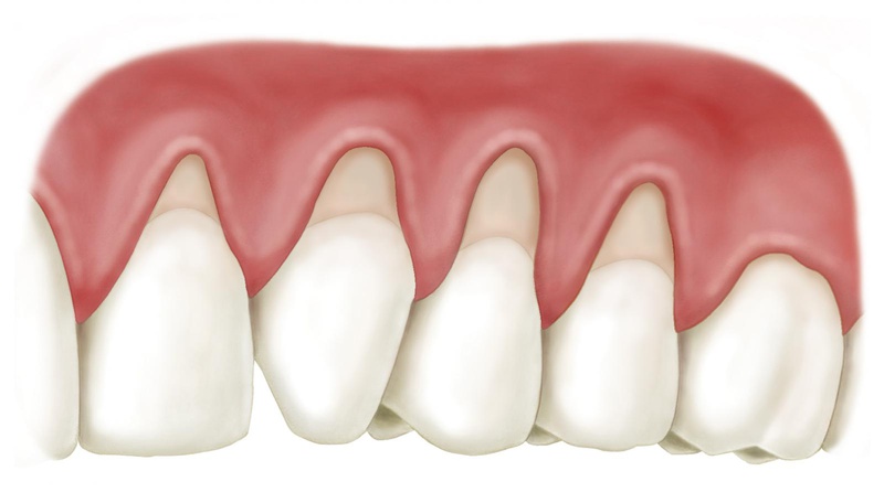 Vệ sinh răng miệng kém gây chảy máu chân răng