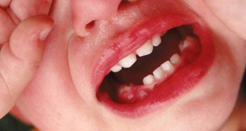 Chảy máu chân răng trẻ em: Nguyên nhân và cách điều trị 1