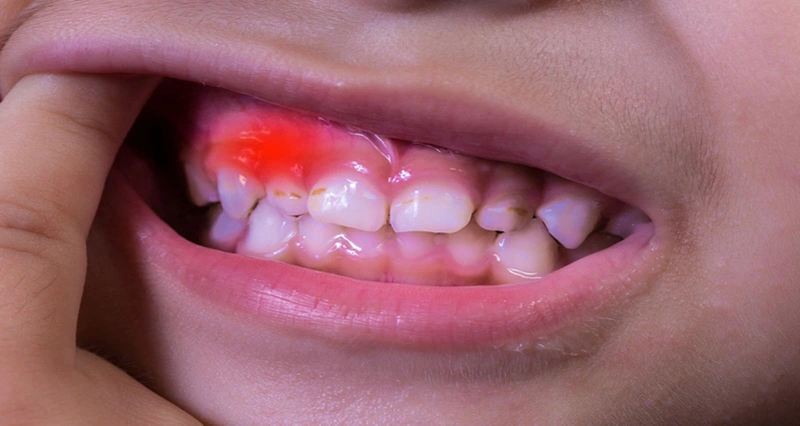 Chảy máu chân răng trẻ em: Nguyên nhân và cách điều trị 2