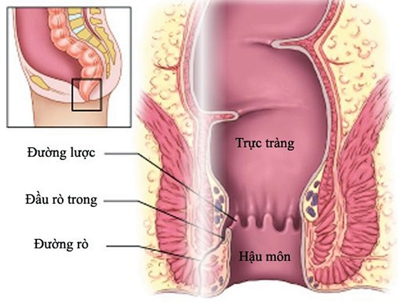 Chảy máu hậu môn là do đâu