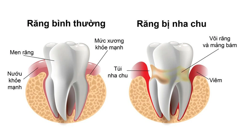 Chảy máu răng không cầm được: Một dấu hiệu nguy hiểm 2