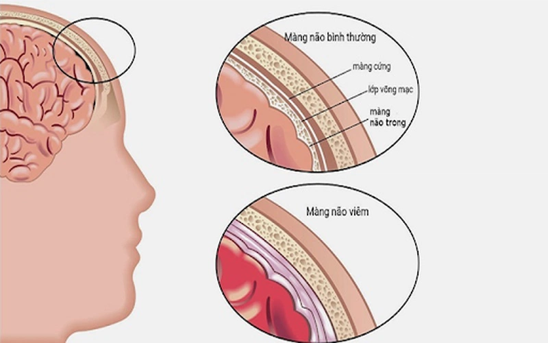 Lao màng não và chi phí điều trị lao màng não 4