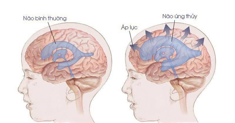 Chi phí phẫu thuật não úng thủy ở trẻ là bao nhiêu? Biện pháp phòng ngừa não úng thủy ở trẻ 1