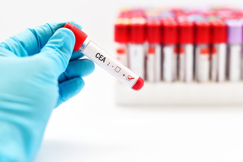 Chỉ số CEA trong xét nghiệm máu là gì? Tìm hiểu chi tiết và ý nghĩa quan trọng
