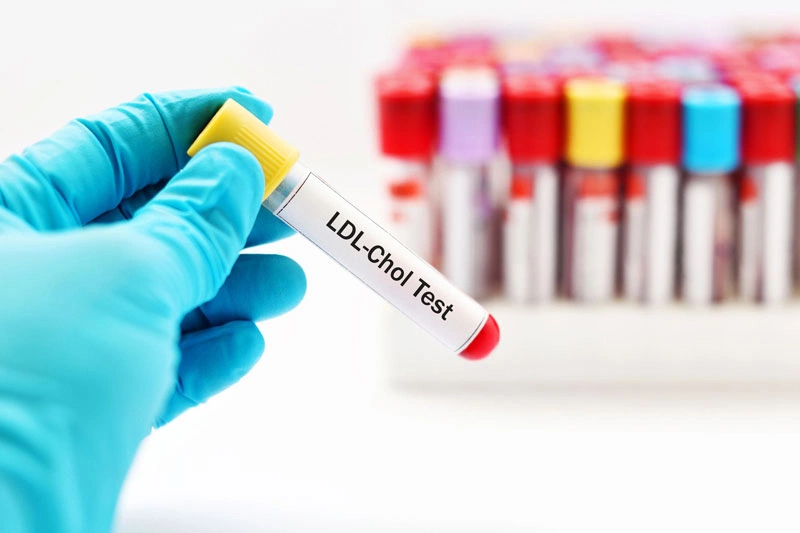 Chỉ số LDL-C trong máu có ý nghĩa gì? 2