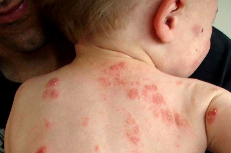 Chốc lở bọng nước ở trẻ em là do đâu và phòng ngừa như thế nào?
