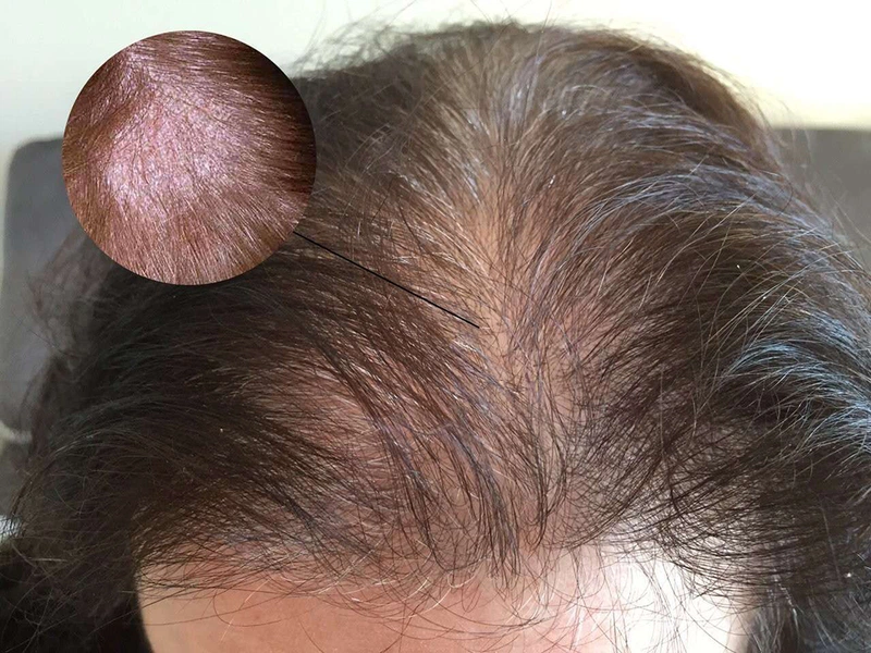 Chốc lở trên đầu có nguy hiểm không? Nguyên nhân và cách chữa trị 3