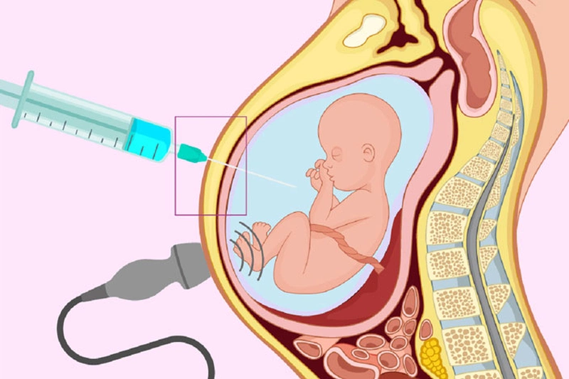 Chọc ối có đau không? Thời gian chọc ối phù hợp nhất các mẹ bầu nên biết 2