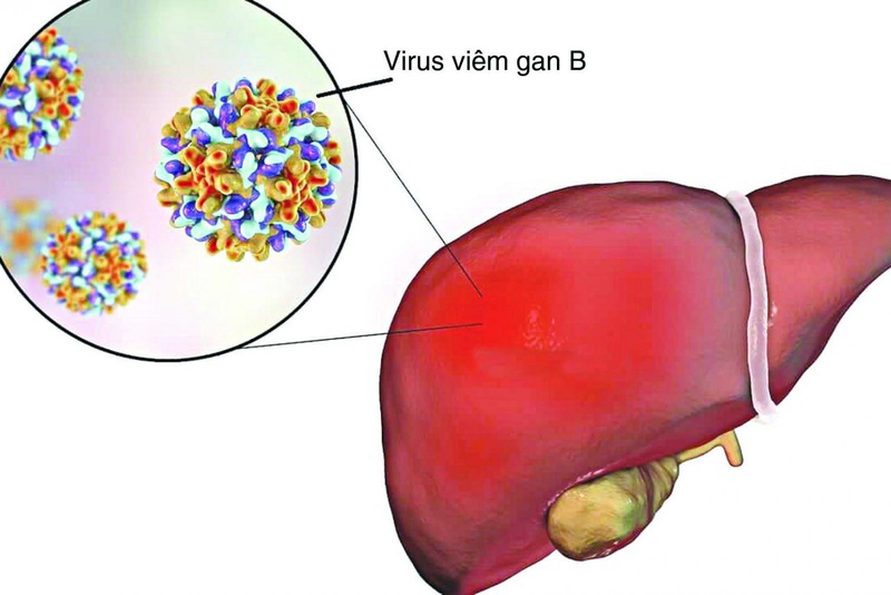 Viêm gan B có thể lây nhiễm qua nhiều đường