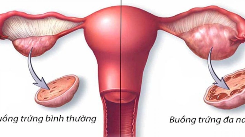 Chu kỳ kinh nguyệt 45 ngày có bình thường không? 4