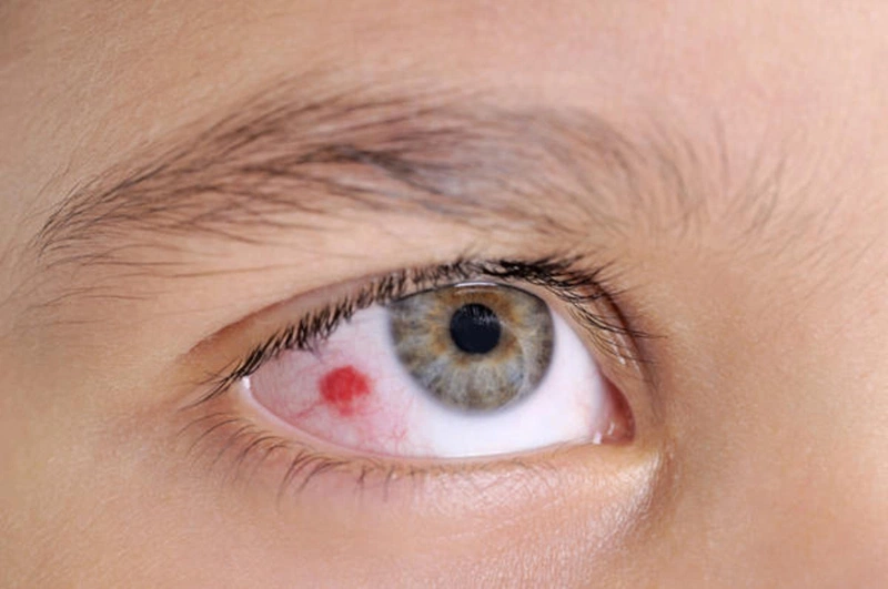Chảy máu mắt là gì? Chẩn đoán và điều trị chảy máu mắt 1