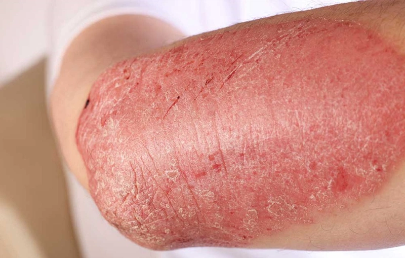 Làm gì để chữa bệnh vảy nến á sừng khỏi hẳn không tái phát 1