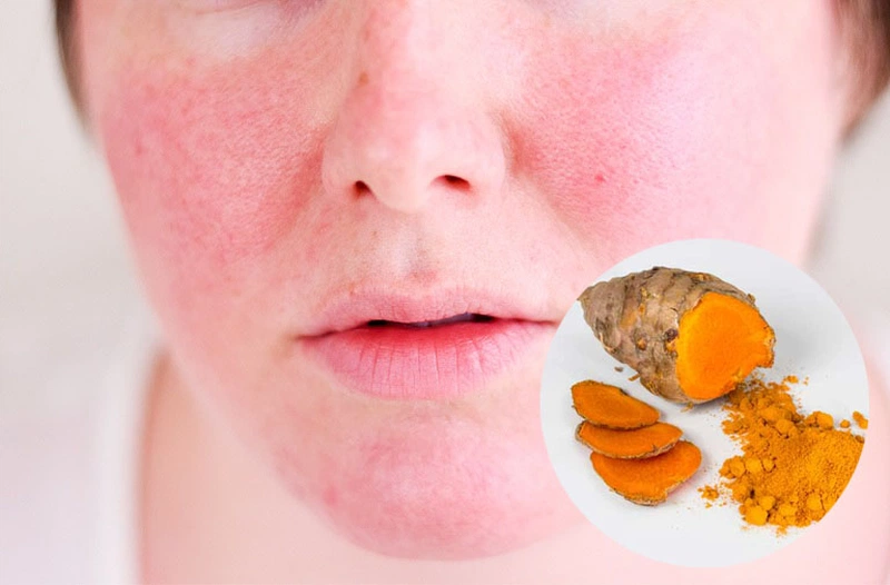 Những điều cần biết về da mặt dị ứng với nghệ và cách chữa trị an toàn ngay tại nhà 1