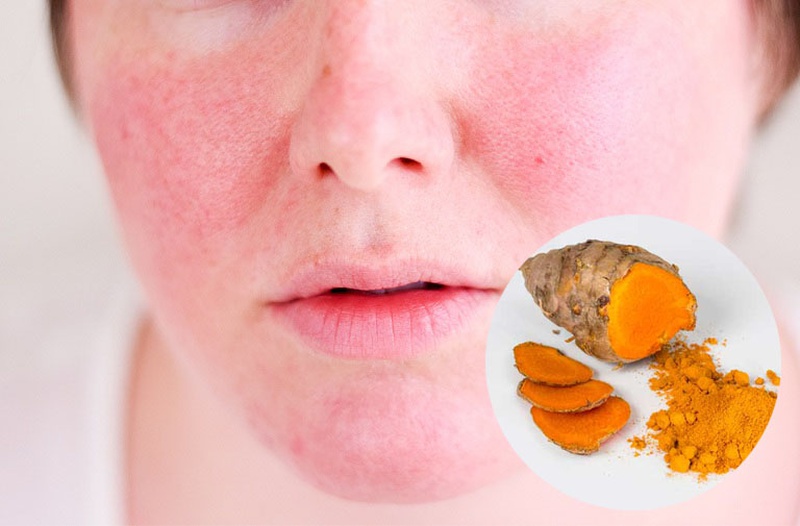 Có hay không trường hợp da mặt dị ứng với mật ong và cách xử lý? 3