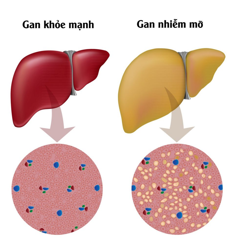 Chỉ bạn 5 bài thuốc nam từ trà khô chữa gan nhiễm mỡ hiệu quả 1
