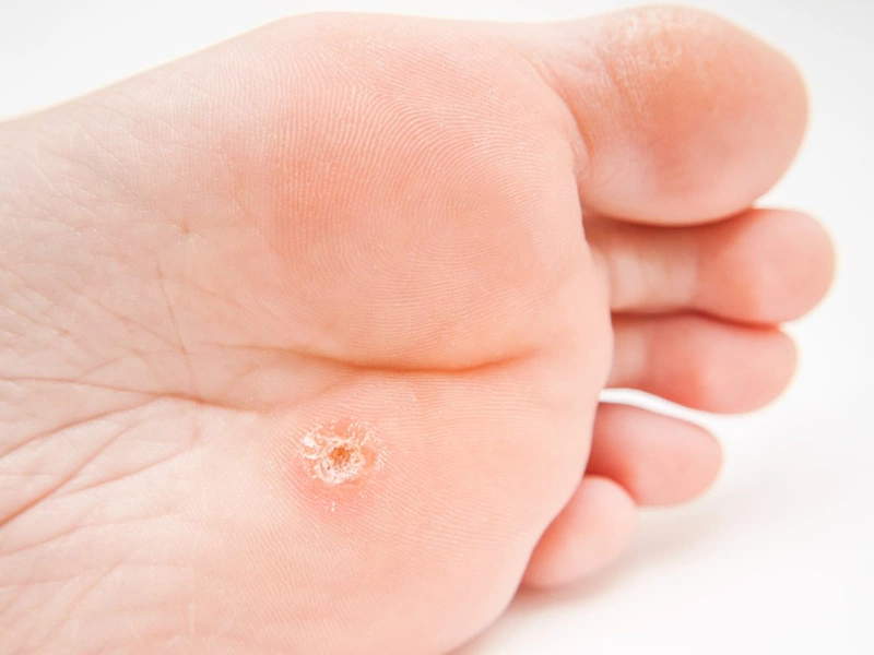 Vài nét về phương pháp chữa mụn cóc bằng băng keo 1