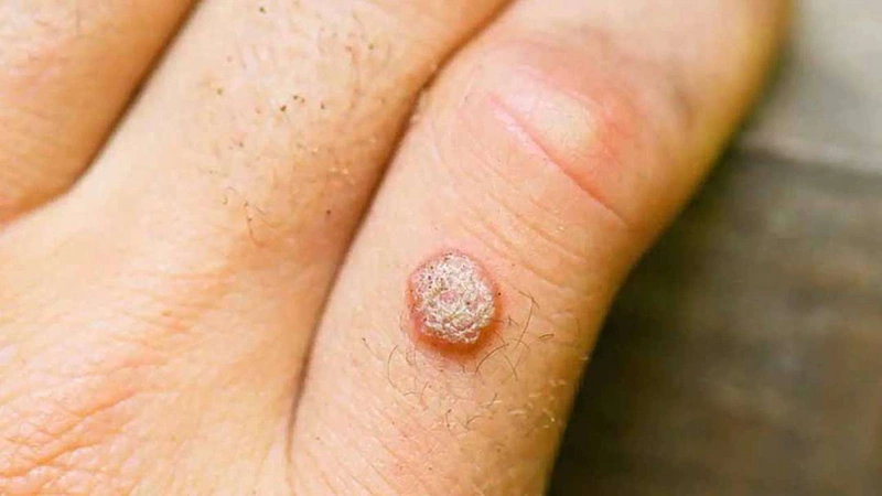 Vài nét về phương pháp chữa mụn cóc bằng băng keo 5