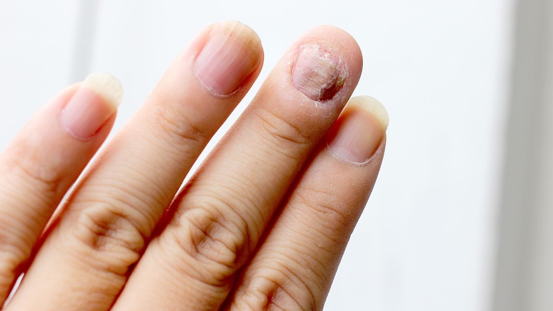 Chữa nấm móng tay bằng tỏi đem lại hiệu quả bất ngờ 1