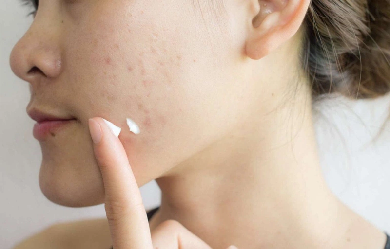 chữa sẹo lõm sau khi tẩy nốt ruồi 6