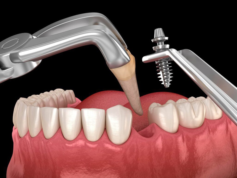 chữa tủy răng số 7 3