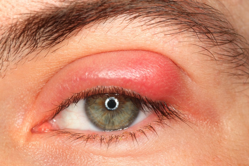 Chứng ngứa mắt: Nguyên nhân phổ biến và cách khắc phục 4