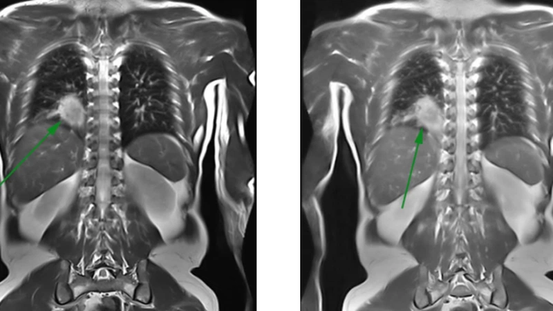 Chụp MRI phổi có vai trò gì? Cần lưu ý điều gì trước khi chụp MRI phổi? 2