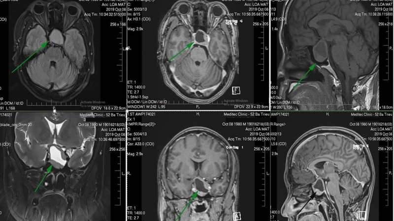 Chụp MRI cần chuẩn bị gì khi có thuốc đối quang từ?-1