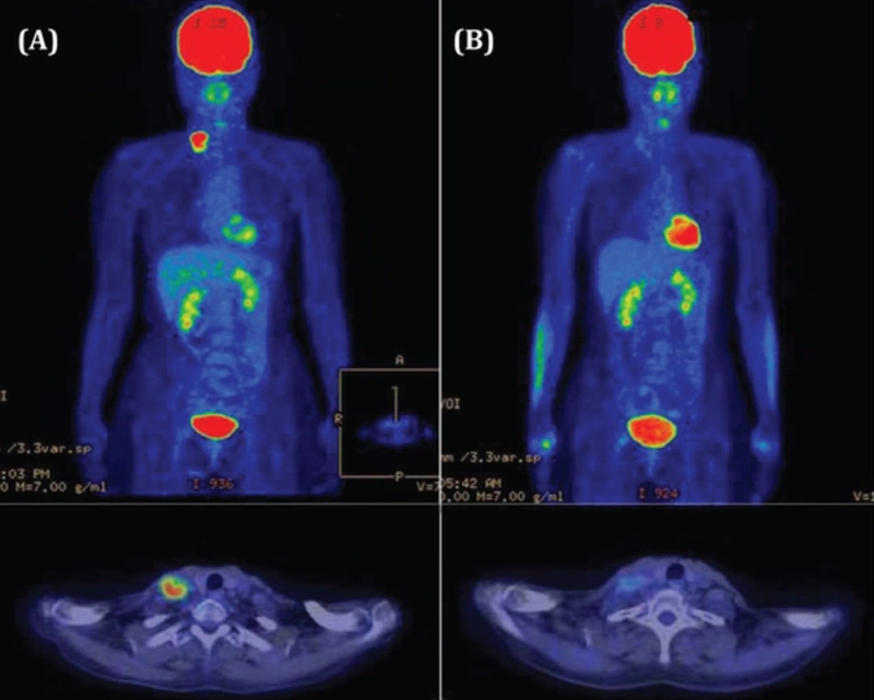 Chụp PET CT là gì? Khi nào cần chụp?-1