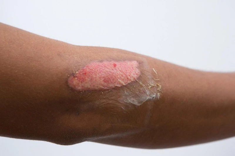 Cấp độ bỏng được chia thành nhiều mức dựa trên tình trạng tổn thương của da.