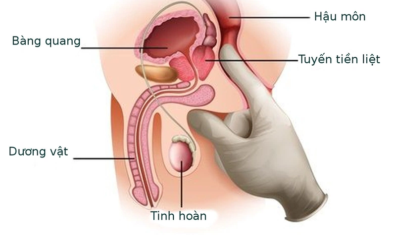Vôi hoá tuyến tiền liệt không gây khó chịu cho người bệnh