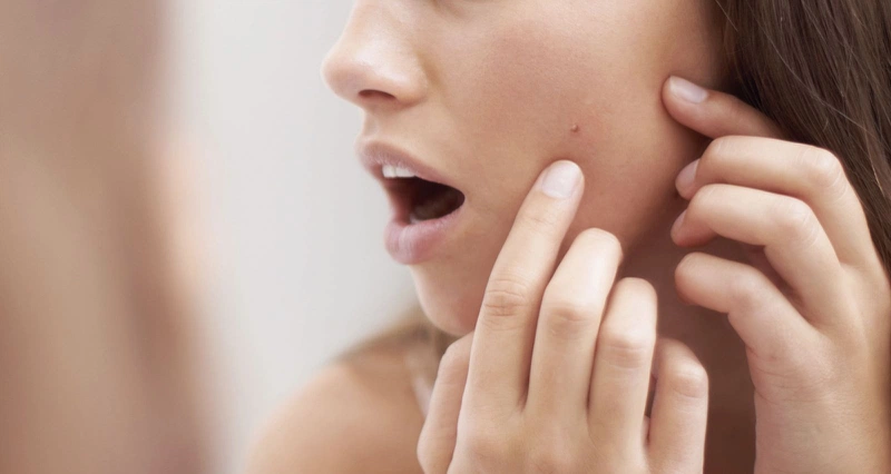 Có nên đi nặn mụn ở spa không? Ưu và nhược điểm khi đi lấy nhân mụn tại spa1