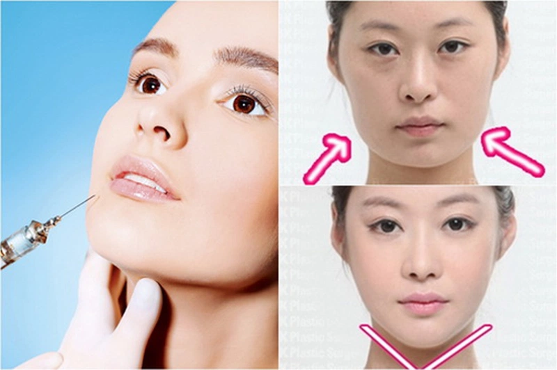 Có nên độn cằm bằng mỡ tự thân hay không?2