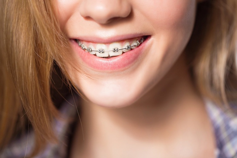 Đối với người đang niềng răng bàn chải đánh răng điện có thể giúp làm sạch trong và xung quanh các bộ phận kim loại của mắc cài
