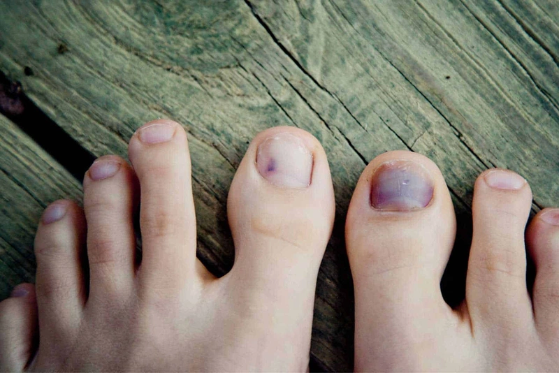 Có nên lấy khoé móng chân không? Cách để lấy khóe móng chân an toàn3