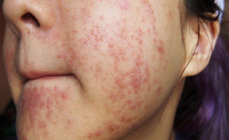 Có nên xông mặt trị dị ứng mỹ phẩm hay không? 1