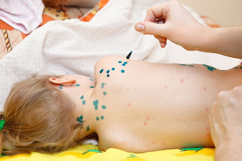 Có thể bị thủy đậu mấy lần trong đời 2