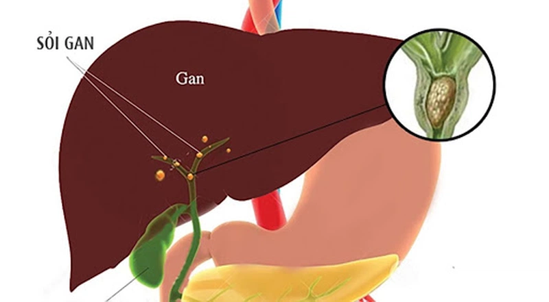 Cơ thể quá gầy cũng dễ dẫn đến hình thành sỏi gan