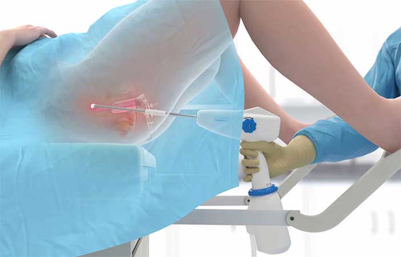 Điều trị nang naboth bằng phương pháp đốt điện