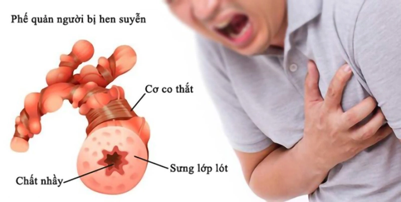 Sơ cứu hen phế quản 1