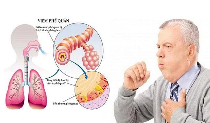 Huyệt phế du hỗ trợ điều trị viêm phế quản hoặc một số bệnh lý liên quan đến phổi