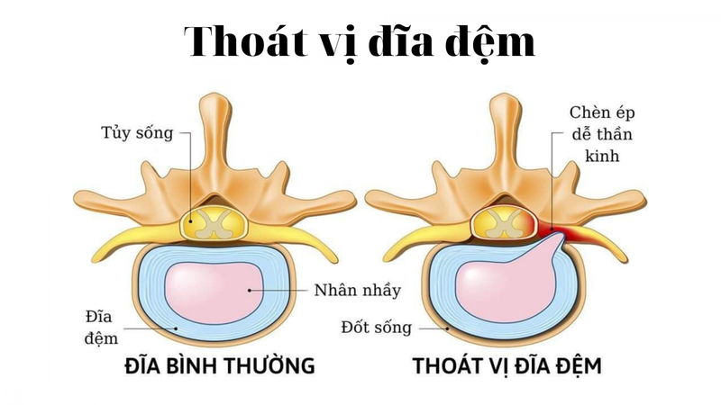 Cột sống của chúng ta “thần kỳ” như thế nào? 3