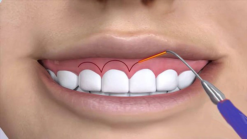 Cười hở lợi là gì? Có thể cải thiện tình trạng cười hở lợi như thế nào? 2