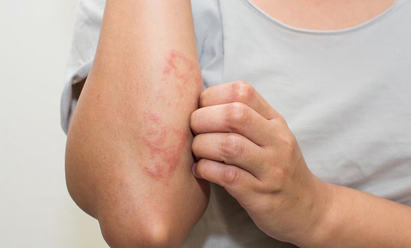 Da bị dị ứng xà phòng phải làm sao? 3