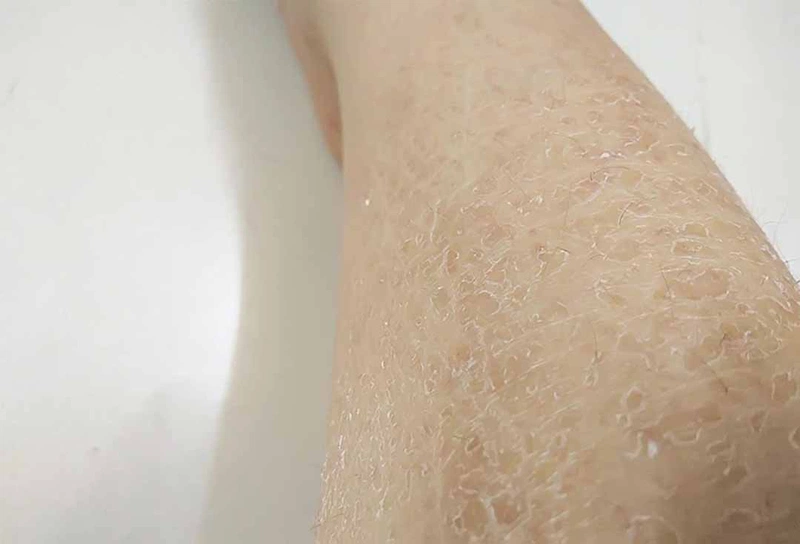 Nguyên nhân da chân bị tróc vảy trắng