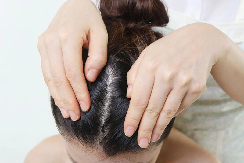 Cách trị gàu bằng dầu dừa cực đơn giản 1