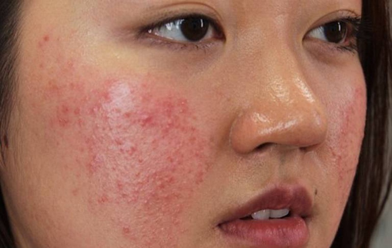 Cách xử lý khi gặp phải tình trạng dị ứng da mặt sần sùi - Nhà thuốc ...