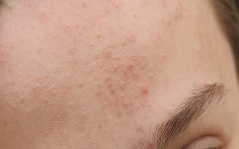 Giải đáp thắc mắc: Thuốc bôi dị ứng trên da mặt Histamin 2