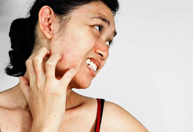 Hướng dẫn trị dị ứng da mặt bằng dầu dừa hiệu quả 1