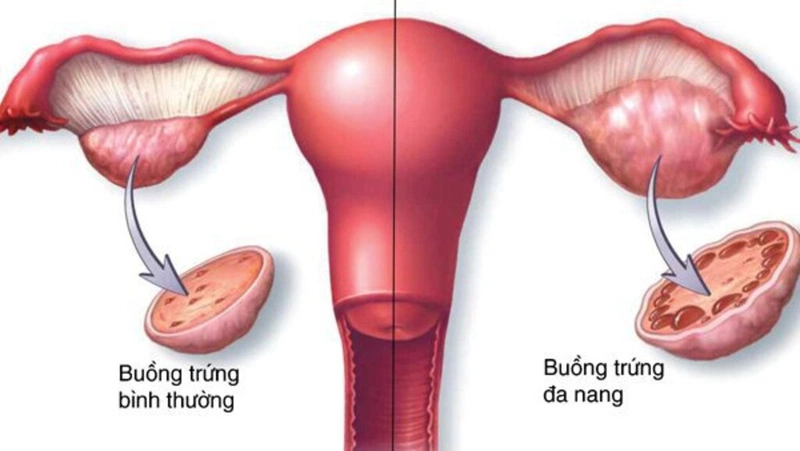 Đa nang buồng trứng có làm IUI được không? 1